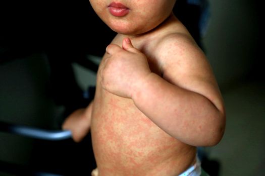 salvador, bahia / brazil - february 14, 2017: Child with measles symptoms is seen with small red spots on body and feverish state.