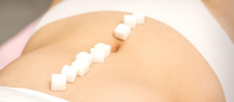 The concept of epilation, waxing. Sugar cubes lying in a row on the abdomen of a young white woman, close up