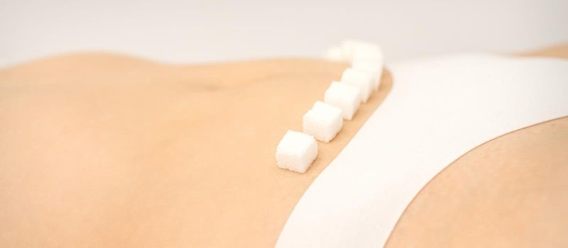 The concept of epilation, waxing, and intimate hygiene. Sugar cubes lying in a row on the bikini zone of a young white woman, close up