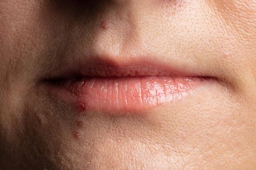 human lips close up with pimples on the face.
