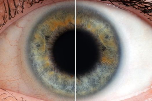 human eye with blood vessels before and after.