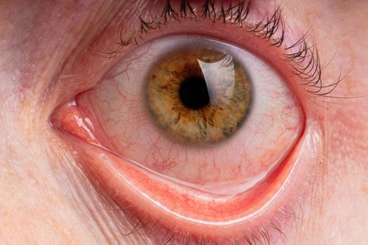 tired brown eye with blood vessels.