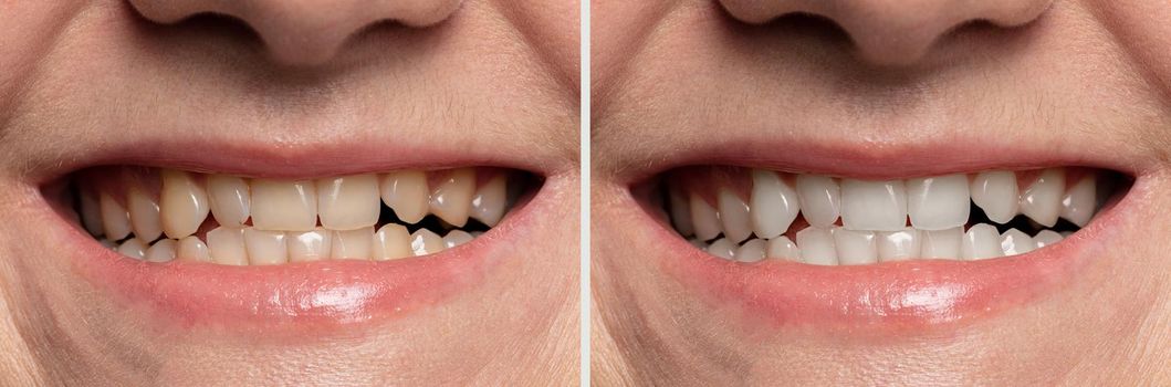 teeth whitening before and after close-up.