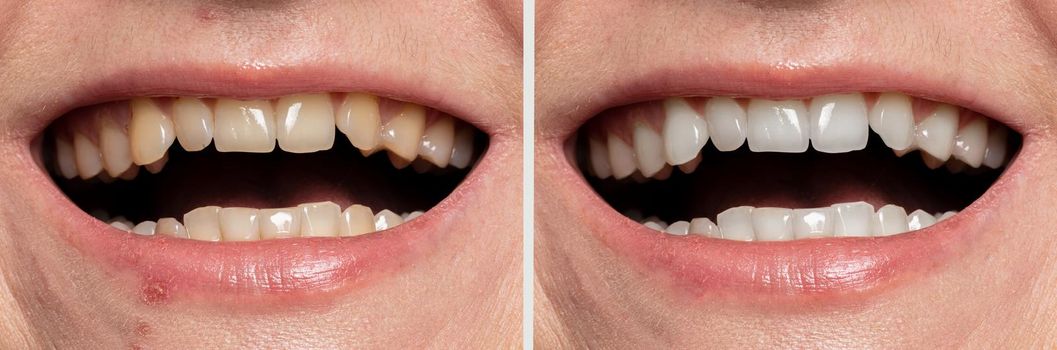 teeth whitening before and after.