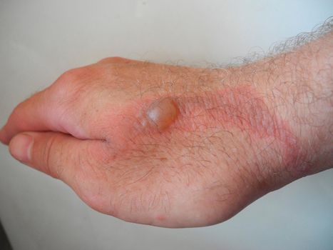 Horrible burns on male hand on gray background.