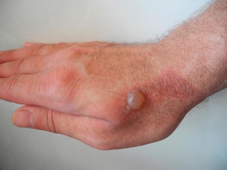 Horrible burns on male hand on gray background.