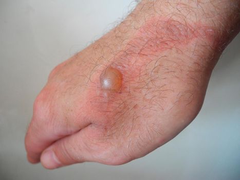 Horrible burns on male hand on gray background.