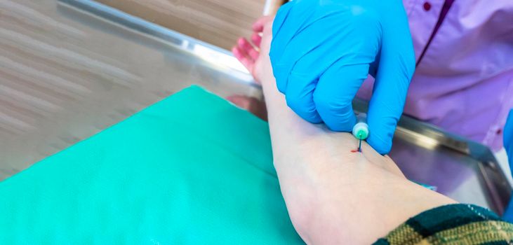 Close up nurse pricking needle syringe in the arm patient drawing blood sample for blood test