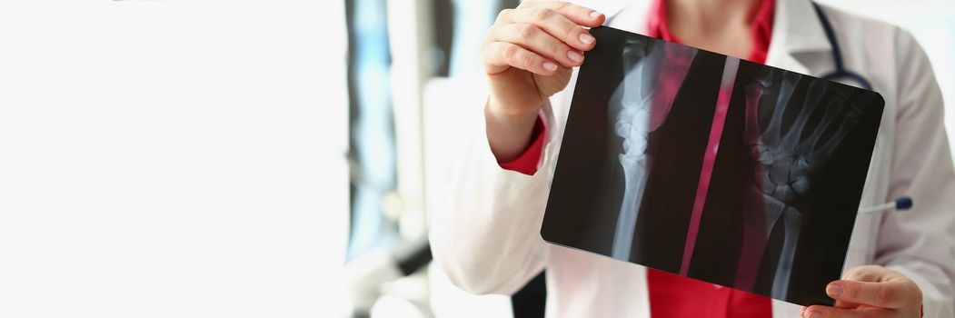 Close-up of medical worker analyzing patient hand xray result, injury. Specialist in uniform examine patient scan, prepare conclusion. Healthcare concept