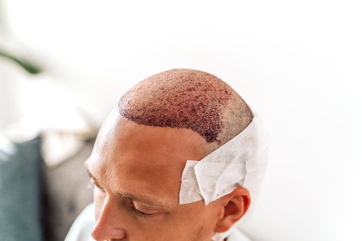 After hair transplantation surgical technique that moves hair follicles. Young bald man in bandage with hair loss problems.