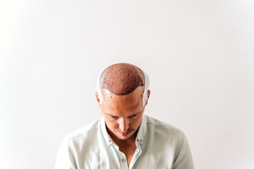 After hair transplantation surgical technique that moves hair follicles. Young bald man in bandage with hair loss problems. White background with copy space.