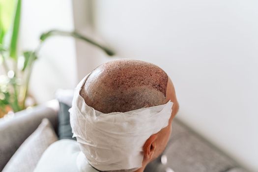 After hair transplantation surgical technique that moves hair follicles. Young bald man in bandage with hair loss problems.