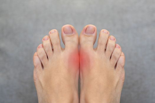 Toe pain may cause from bone fracture, tendinitis, ligament sprain, osteoarthritis, gouty arthritis, rheumatoid arthritis.