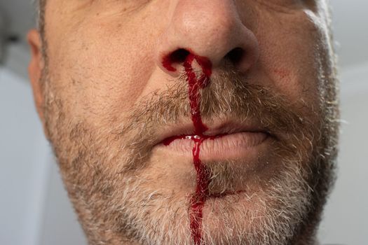 Nosebleed , an old man with a bloody nose. Healthcare and medical concept.