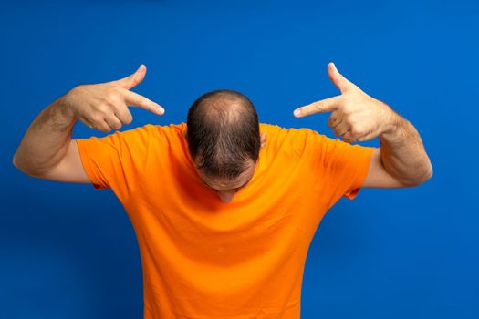 Human alopecia or hair loss. Middle-aged Latino man pointing to his head highlighting his incipient alopecia.