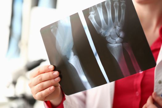 Doctor holding x-ray of hands in clinic. X-ray wrist traumatology and health care concept
