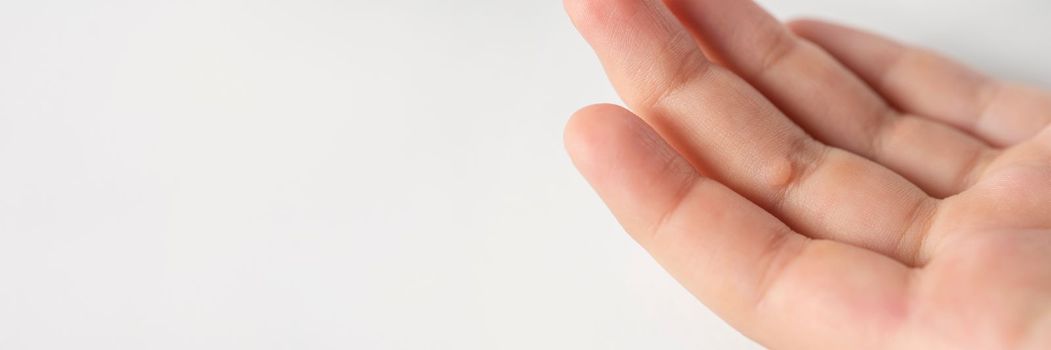 Wart on the finger. Close-up of a wart on a child's finger. The common wart Verruca vulgaris is caused by a type of human papillomavirus, HPV