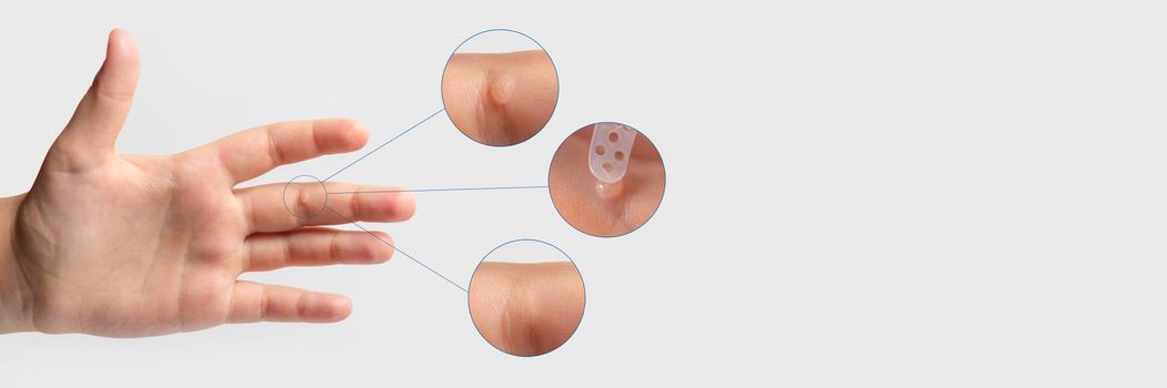 Wart on the finger. Close-up of wart treatment before and after. Apply the medicine to the wart. Human papillomavirus, HPV, copy space