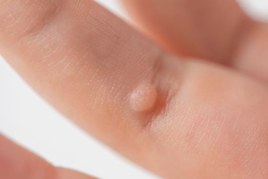 Wart on the finger. Close-up of a wart on a child's finger. The common wart Verruca vulgaris is caused by a type of human papillomavirus, HPV