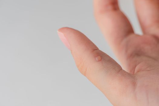 Wart on hand. The concept of treating warts and other skin defects. Close-up of a wart on a finger, a benign growth on human skin