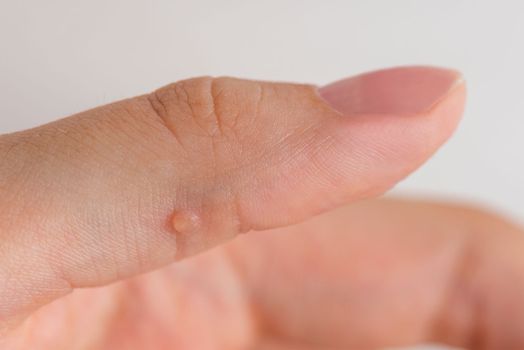 Wart on hand. The concept of treating warts and other skin defects. Close-up of a wart on a finger, a benign growth on human skin