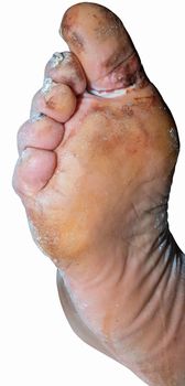 Injured foot of an elderly man on a white background.
