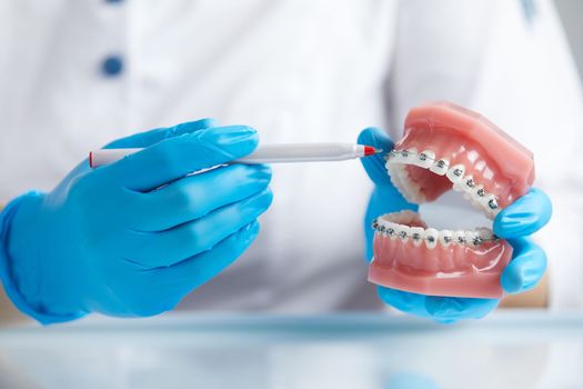 Orthodontist shows how the system of braces on teeth is arranged on an artificial jaws