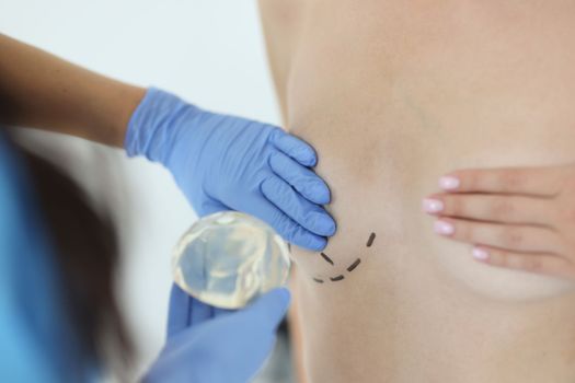 Surgeon holds silicone implant for breast augmentation. Restoration of the breast in women after partial or complete removal oncology concept