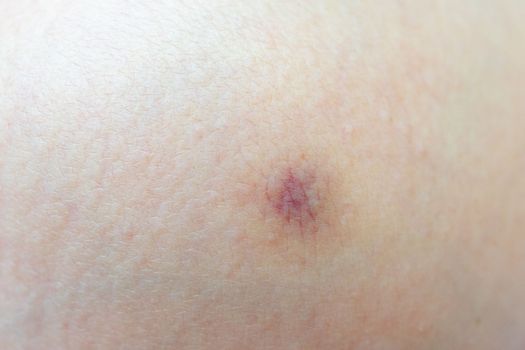 Close-up of a small bruise on a human body.