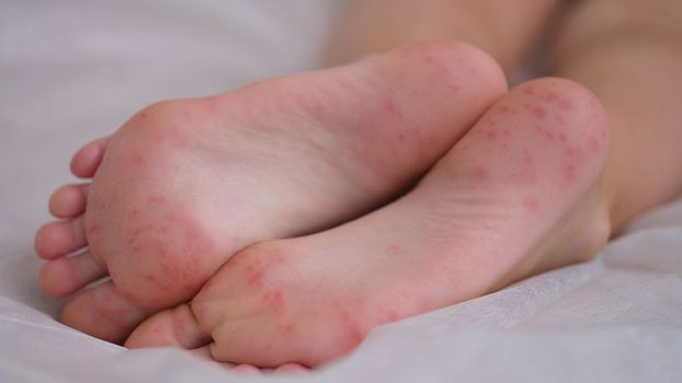 Eczema is an irritation caused by an allergic lesion of skin of feet in child. Infectious skin diseases in children