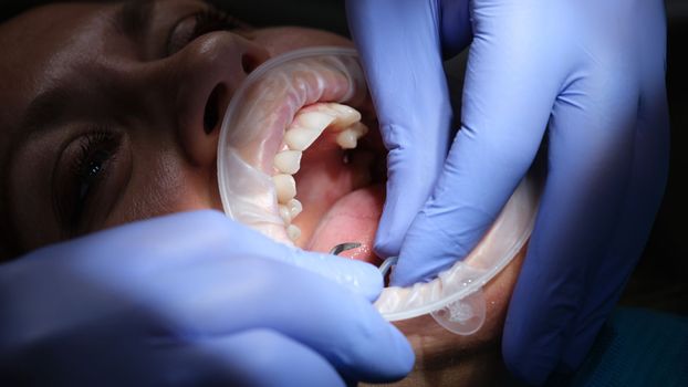 Dentist prepares female teeth for installation of ceramic veneers and crowns and removing enamel. Treatment at orthodontist concept