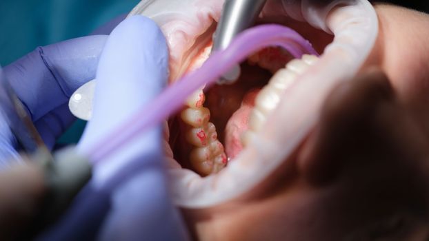 Dentist prepares woman teeth for installation of ceramic veneers and crowns using drill. Doctor removes part of tooth enamel