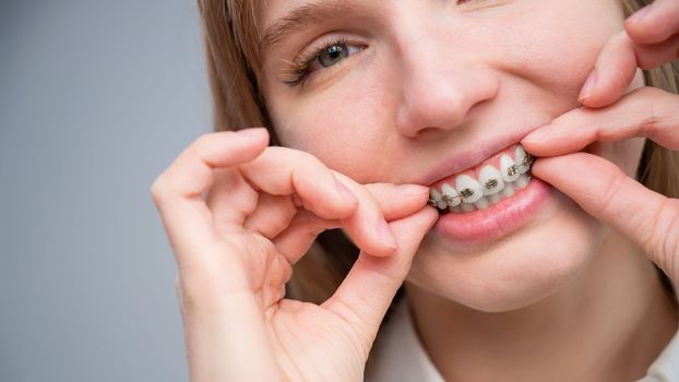 Close-up portrait of a red-haired girl touching braces. Young woman corrects bite with orthodontic appliance