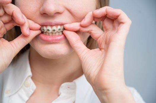 Close-up portrait of a red-haired girl touching braces. Young woman corrects bite with orthodontic appliance