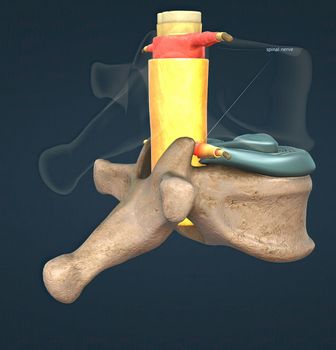 A slipped disc may also be called a prolapsed or herniated disc. 3d illustration