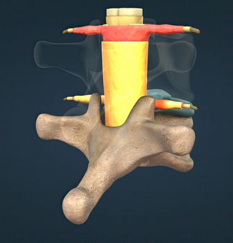 A slipped disc may also be called a prolapsed or herniated disc. 3d illustration