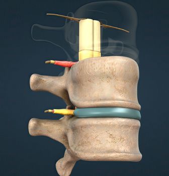 The spinal nerve is a mixed nerve that carries motor, sensory and autonomic signals between the spinal cord and the body