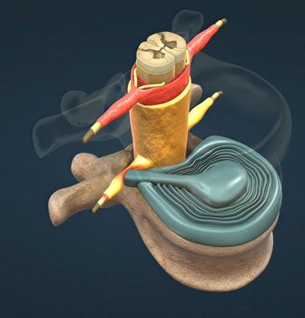 A slipped disc may also be called a prolapsed or herniated disc. 3d illustration