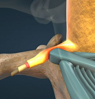 A slipped disc may also be called a prolapsed or herniated disc. 3d illustration