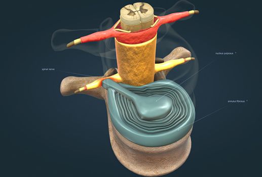 A slipped disc may also be called a prolapsed or herniated disc. 3d illustration