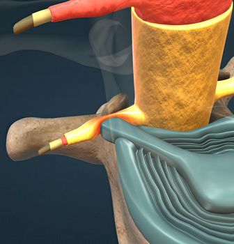 A slipped disc may also be called a prolapsed or herniated disc. 3d illustration