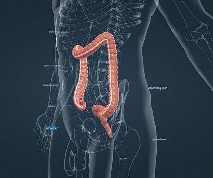Appendicitis is inflammation of the appendix, a finger-shaped sac protruding from your colon on the lower right side of your abdomen. Appendicitis causes pain in the lower right abdomen. 3d illustration