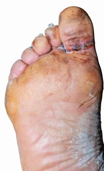 A large laceration between the big toe and the foot.