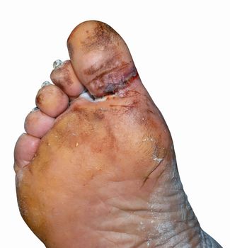 A large laceration between the big toe and the foot.