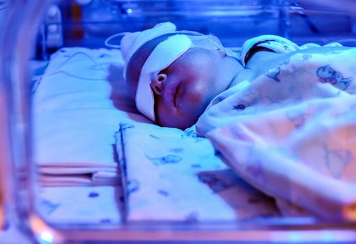 a premature baby lies under an ultraviolet lamp in an incubator