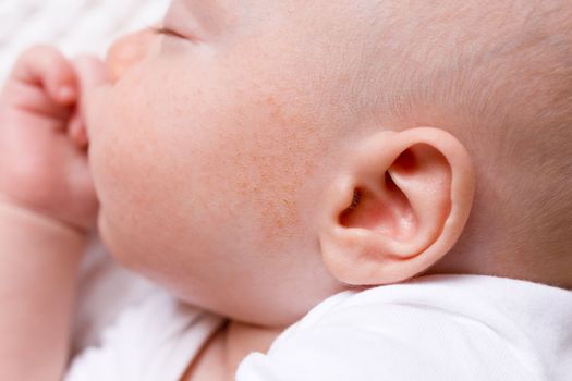 baby infant cheeks close-up dermatitis or allergic skin rash