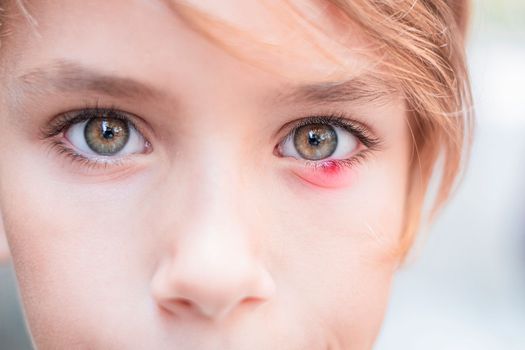 Closeup of a child eye stye. Ophthalmic hordeolum disease.