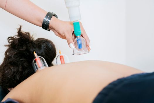 Physiotherapist placing cupping on lying patient, Close up of professional performing cupping treatment on patient, Modern Physiotherapy with cupping cups