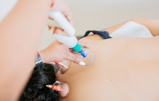 Modern physiotherapy with cupping, Professional hands placing therapeutic cupping. Physiotherapist placing cupping on patient, Professional physiotherapy treatment with cupping on a lying patient