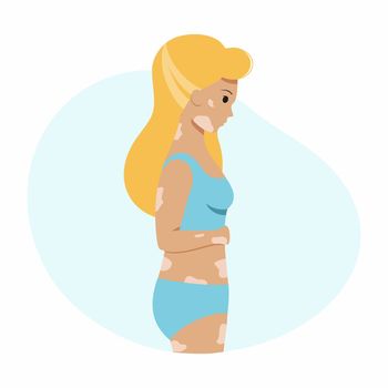 A girl with vitiligo on her skin. A woman with a pigmentation spot and a swimsuit. Vector character in a flat style .